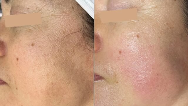 B&A1
